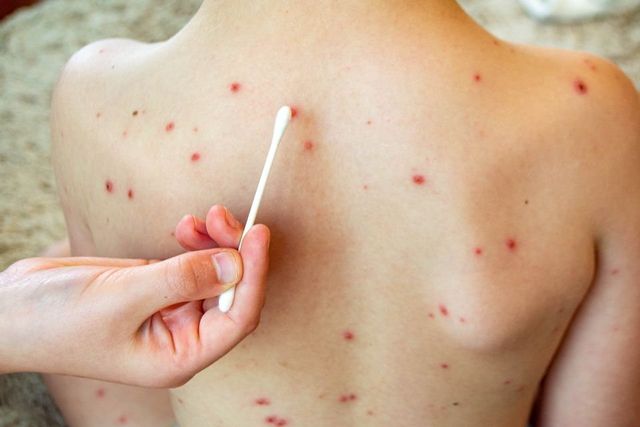 Measles cases